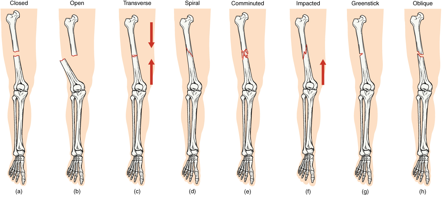 Fractures Bone Repair Anatomy and Physiology I Course Hero