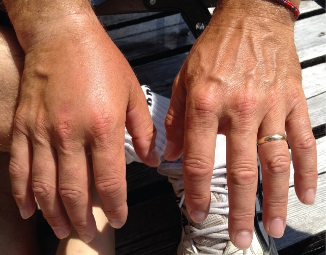 This photo shows the dorsal surfaces of a person’s right and left hands. The left hand is normal, with the several blood vessels visible under the skin. However, the top of the right hand is swollen and no blood vessels are visible.