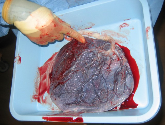 This is a photo of a placenta and umbilical cord post-expulsion.