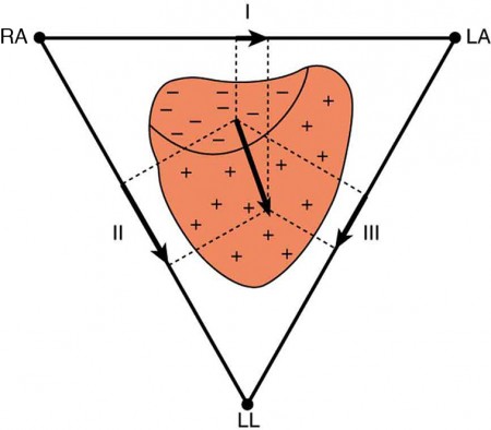 The figure shows that the charge distribution on the outer surface of the heart changes from positive to negative during depolarization. This wave of depolarization, spreading from the upper right toward the lower left of the heart, is represented by a vector pointing in the direction of the wave. The components of this vector are measured by placing electrodes on the patient’s chest. The figure shows three electrodes, labeled R A, L A, and L L, placed to form a triangle around the heart. The electrode R A is close to the right atrium, L A is close to the left atrium, and L L is just below the heart. R A and L A form a pair called lead one, R A and L L form a second pair called lead two, and L A and L L form a third pair called lead three. Each pair of electrodes measures a component of the depolarization vector.