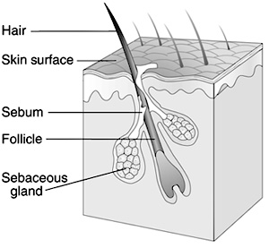 This is a cross-section of a hair follicle. The sebum, follicle, and sebaceous gland are seen under the skin.