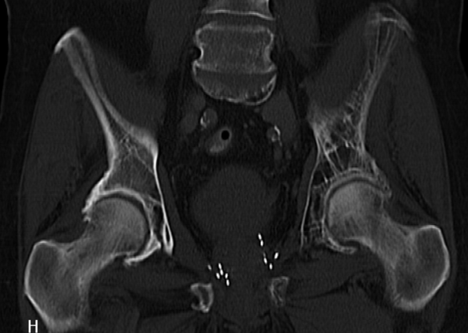 This image is an X-ray of the pelvis with Paget's disease. While the right pelvis looks normal, the left pelvis has much more visible outlines and definition, which indicates Paget's disease.