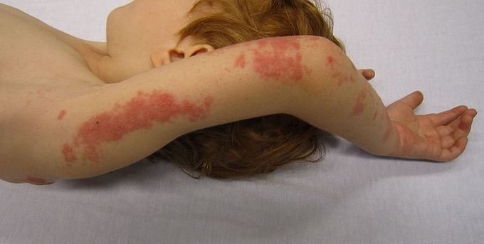 This is a photo of a patient with shingles; the shingles rash appears across a dermatome. In this patient, one of the dermatomes in the arm is affected, restricting the rash to the length of the back of the arm.