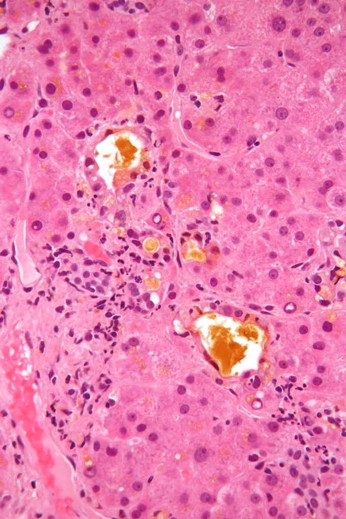 This is a micrograph image of bile (seen as yellow material) in a liver biopsy.
