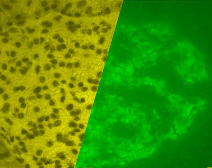 This is a microscope photograph of a porcine islet of Langerhans. On the left is a brightfield image created using hematoxylin stain; nuclei are dark circles and the acinar pancreatic tissue is darker than the islet tissue. The right image is the same section stained by immunofluorescence against insulin, indicating beta cells.