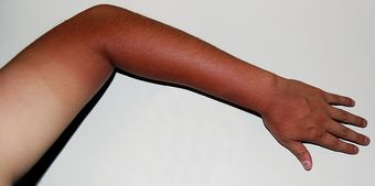 This is a color photo of a sun-tanned arm. Skin exposure to UV radiation through tanning causes changes in the pigmentation of the skin by increasing melanin production.