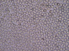 This is a photo about urinalysis. The photo shows white blood cells as seen under a microscope from a urine sample.