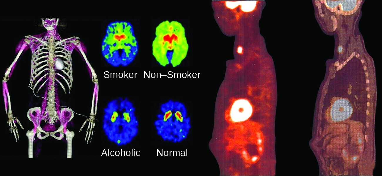 An image shows four sets of medical pictures. The first is the torso and arms of a human skeleton with purple shading in the muscular regions. The second is a set of four images; the top left, labeled “Smoker,” shows an oval-shaped image that is blue on the outside rim, green as you move inward, and bright red near the center while the top right, labeled “Non-Smoker,” shows an oval-shaped image that is shaded bright green over most of the image and bright red near the center. The lower left image of the four, labeled “Alcoholic,” shows an oval-shaped image that is almost entirely blue with two small yellow-rimmed, red dots near the upper middle section while the lower right image, labeled “Normal,” looks very similar to the lower left, but the red regions are slightly larger. The final image show two scans of a human torso that is turned to face to the side. The left scan has three bright yellow-white areas; one in the throat, one in the chest and one in the head. The right scan is the same as the left except the bright regions are dim and the internal organs are more clearly defined.