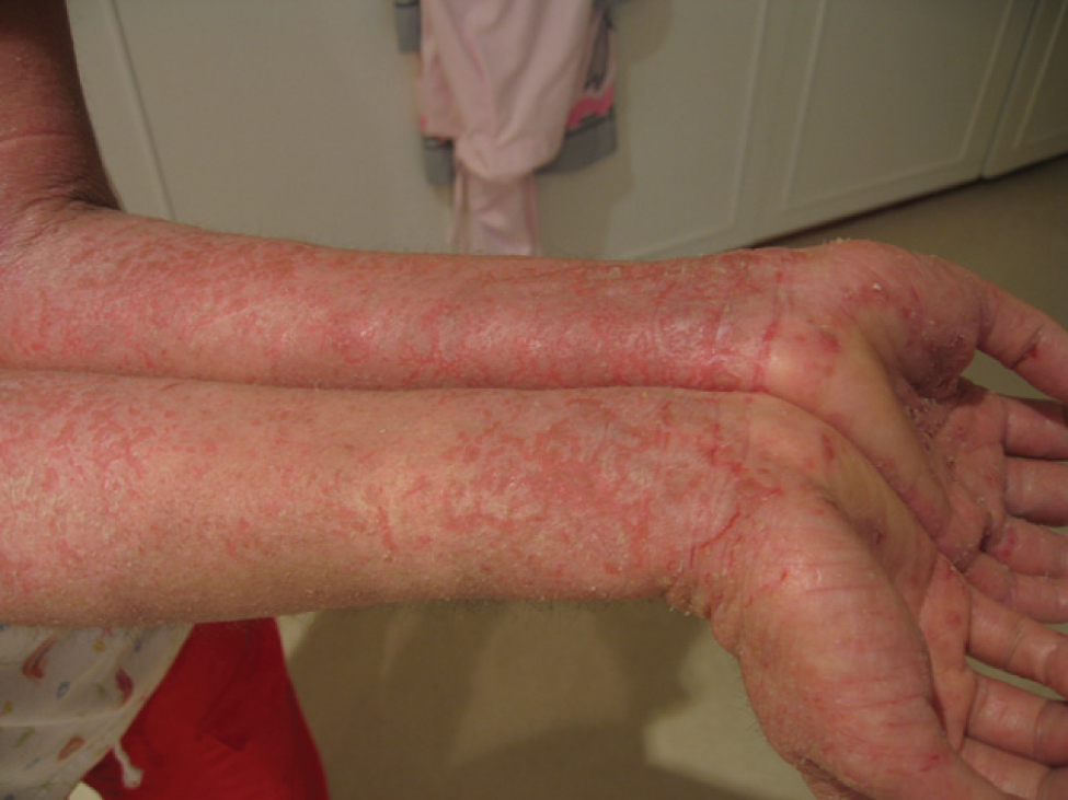 This photo shows a person with eczema on the ventral skin of the forearms. The person is a Caucasian, but his or her white skin is mottled with many red marks, giving it the appearance of a rash. In some areas, the skin is breaking and peeling.