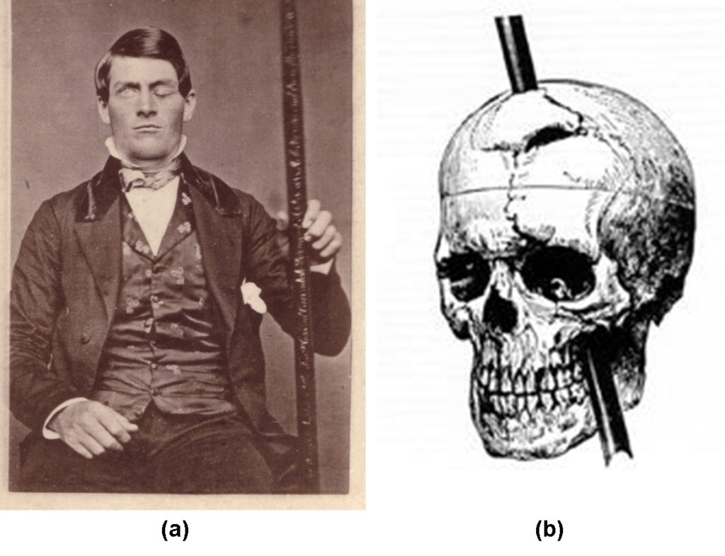 This photo on the left shows Phineas Gage holding the metal spike that impaled his prefrontal cortex. The image on the right shows a drawing of the skull with the metal spike inserted like it would have been when he was injured.