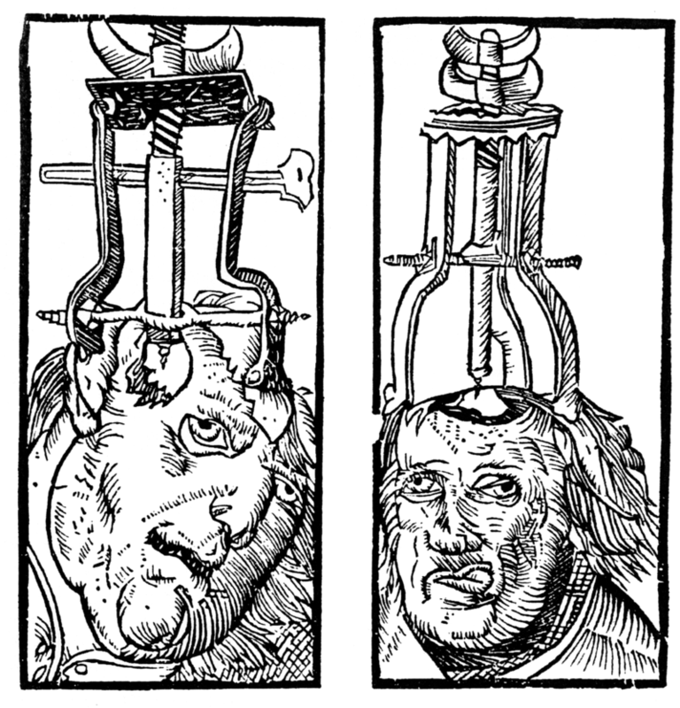 Engraving by Peter Treveris of a trepanation. A type of drill is clamped onto the head and used to bore a hole through the skull and expose the dura matter.