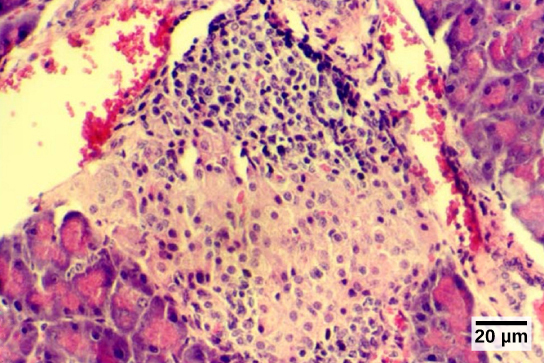 Micrograph shows purple-stained cells in a white tissue. The white tissue is surrounded by tissue that stains pink.