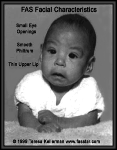 Image of infant with FAS Facial Characteristics, such as small eye openings, smooth philtrum, and a thin upper lip.