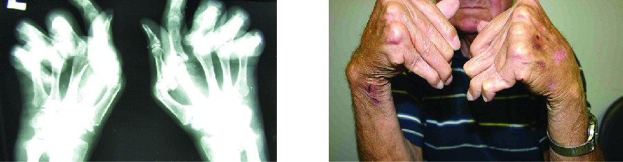 X-ray and photo of hands with joints bent at unusual angles.