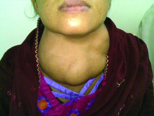 A person with a large swollen neck.