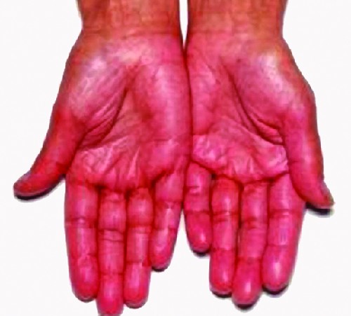Two hands, palm up are shown. They appear to be redder than is normal.