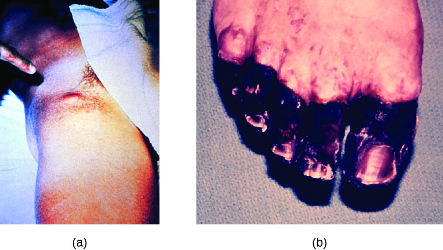part a shows the upper leg of a person with a large red bump near the groin. Part b is a photo of blackened toes.
