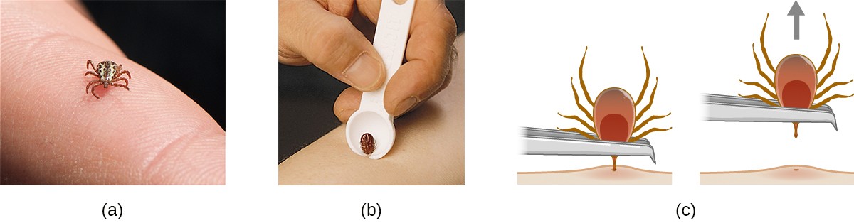 a) A tick on a finger. B) a spoon shaped tool with a notch is used to pull the tick. C) tweezers can be used to pull the tick straight out.