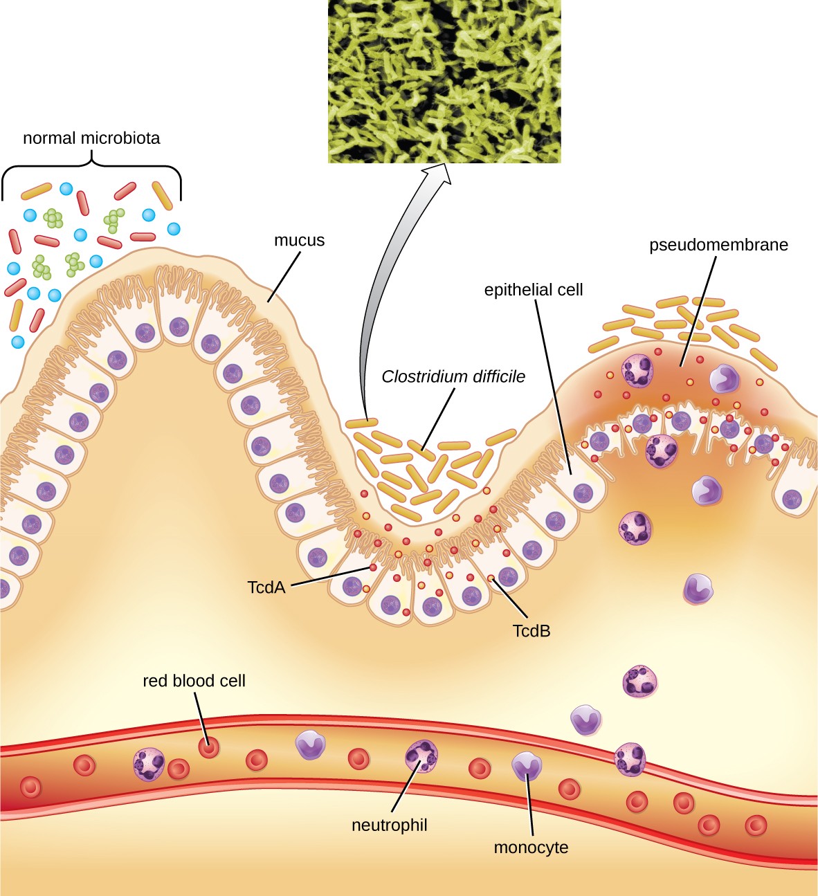 A diagram showing the lining of the stomach. At the very bottom is a blood vessel with red blood cells, neutrophils, and monocytes. At the top is a wavy layer of epithelial cells covered in mucous. A variety of bacteria (different shapes and colors to indicate different species) are seen on the mucus. In one region is a cluster of rod shaped cells labeled Clostridium difficile that release small dots labeled TcdA and TcdB. These create a pseudomembrane that is a swelling above destroyed epithelial cells. In response neutrophils and monocytes released.