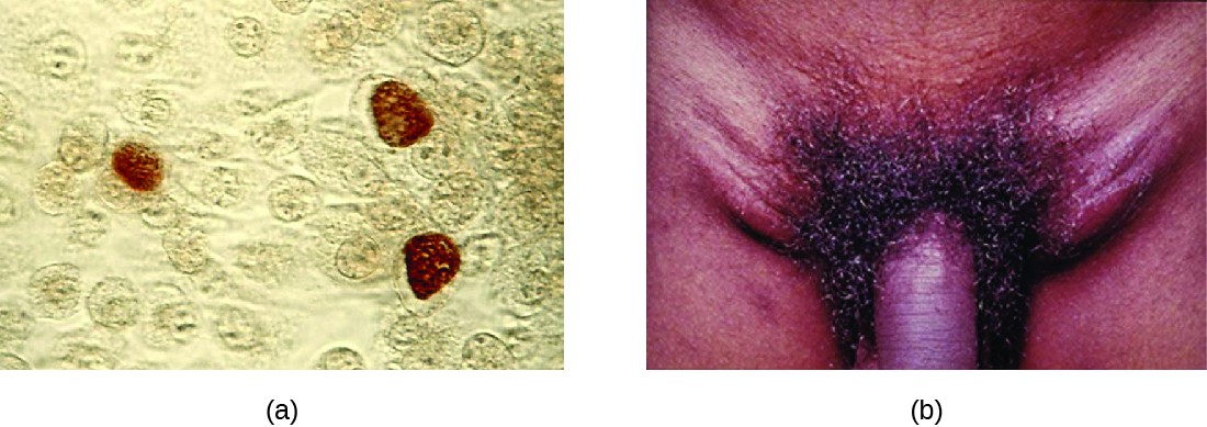 a) Micrograph showing brown coloration inside cells. B) photo of a swollen region on either side of the penis.