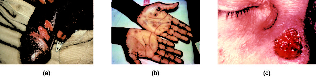 a) Photo of red, open sores on a penis. B) Photo of brown spots on the palm of the hands. C) Photo of a red, open sore on the nose.