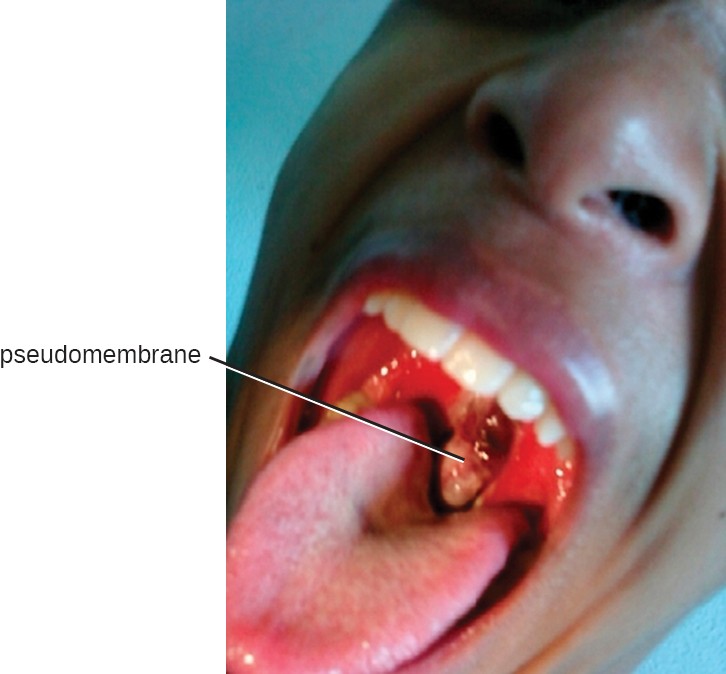 A gray, leathery blob in the back of a person’s mouth is shown and the label 