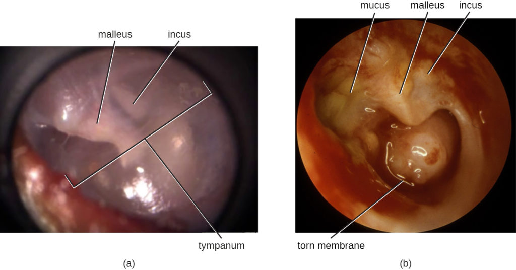 a) A close-up of the ear drum (tympanic membrane) which looks like a translucent, thin covering. Labels point out the malleus, incus, and tympanum. B) Without the tymphanic membrane, the region is red and swollen. The bones are deteriorating and yellow mucus builds up. Labels point to mucus, a torn membrane, and eroded inner ear bones.