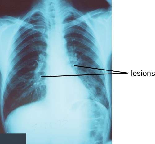 An X-ray that shows white bones on a black background. White regions within the lungs are labeled lesions.