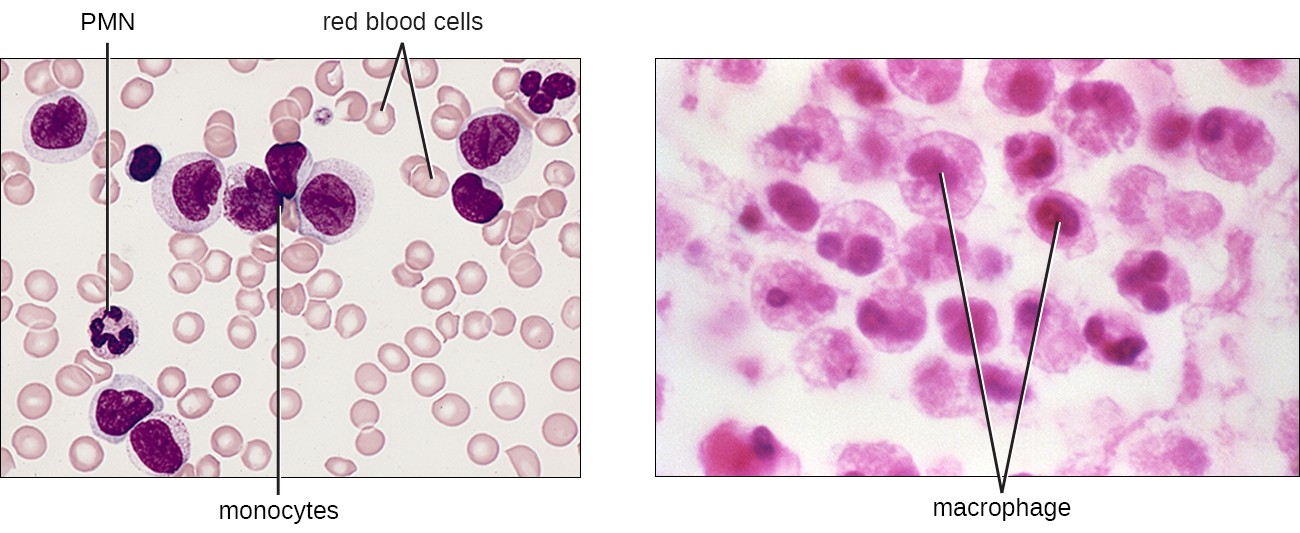 Monocytes are large cells with a large purple nucleus. There is a cluster of them in a field of smaller red blood cells. A PMN is also visible with a dark, multi-lobed nucleus. Macrophages are large cells with a defined nucleus.