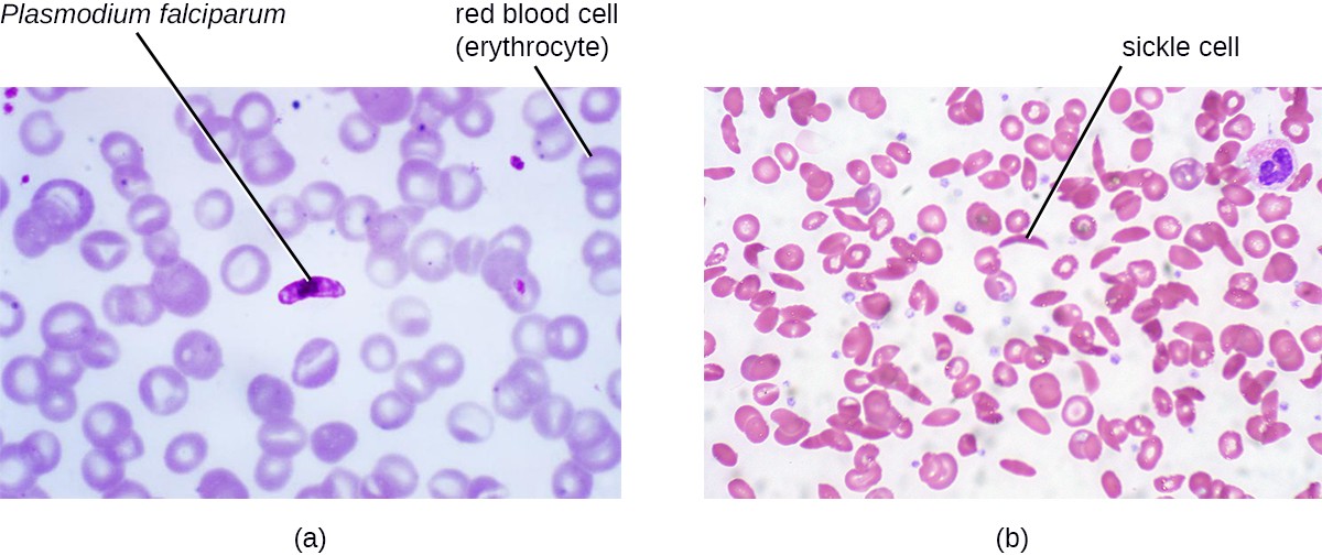 a) A micrograph showing round red blood cells (erythrocytes) and a darker oval cell (Plasmodium falciparum).b) A micrograph showing round red blood cells and a 