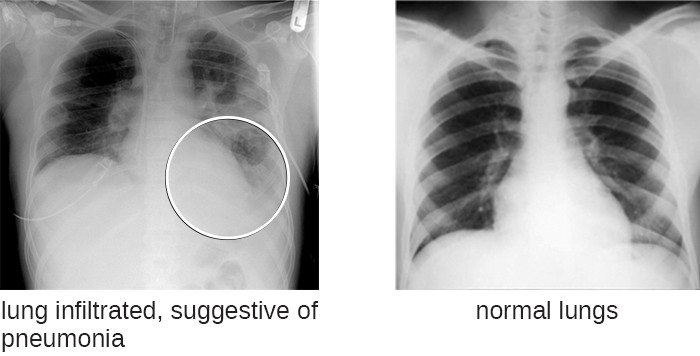 Chest X-rays show ribs and other bones as white and the lungs as black. The left image has significant white cloudiness in the lungs. This lung infiltrate is suggestive of pneumonia. Normal lungs show a smooth, even black color throughout the lungs.
