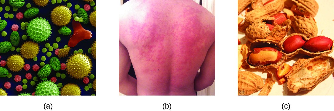 A) micrograph of pollen granules in different shapes and with different surface features. B) photo of a rash on a person’s back. C) Photo of peanuts.