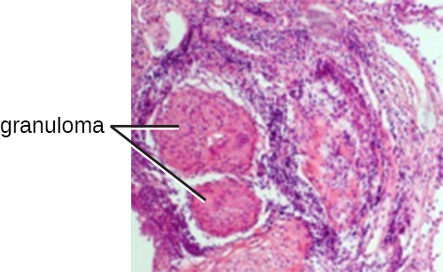 A micrograph of a tubercle which consists of many darkly staining cells that form a circular structure.