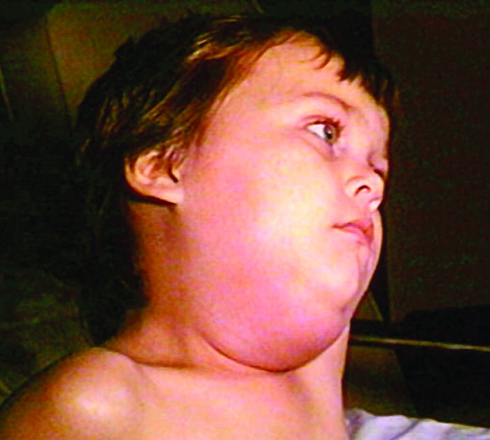 Photo of child with a very large swelling on one side of the neck.