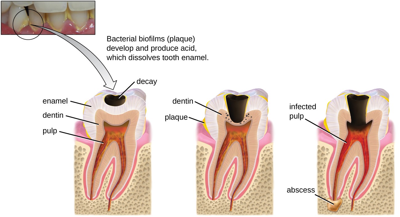 A photo of teeth with yellow plaque; label reads: bacterial biofilms (plaque) develop and produce acid which dissolves tooth enamel. This leads to a diagram showing the process. The first step show a black region labeled decay in the enamel; the dentin and pulp are not yet affected. Yellow material on the tooth and near the region of decay is labeled plaque. Next, the decay expands and is labeled abscess; this reaches the dentin layer. Finally, the abscess expands and causes an infected pulp.