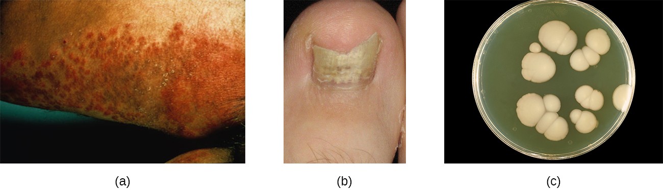 A) a dark, lumpy rash. B) a broken, yellow nail. C) large, white, fuzzy colonies on a plate.