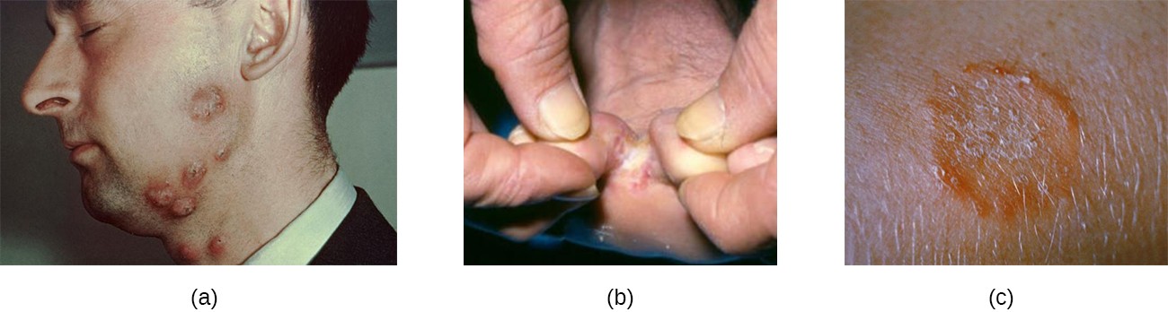 a) large red bumps on a cheek. B) white crusty skin on a foot. C) an orange ring on skin.