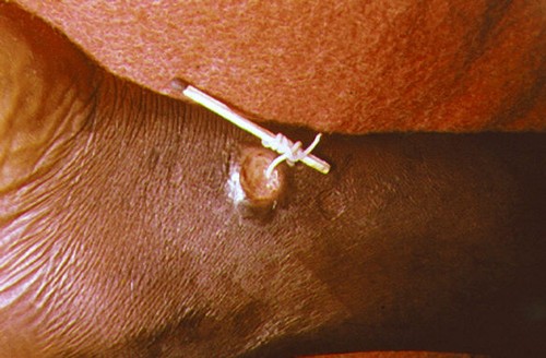 A worm is being pulled out of a wound in the leg of an infected individual.