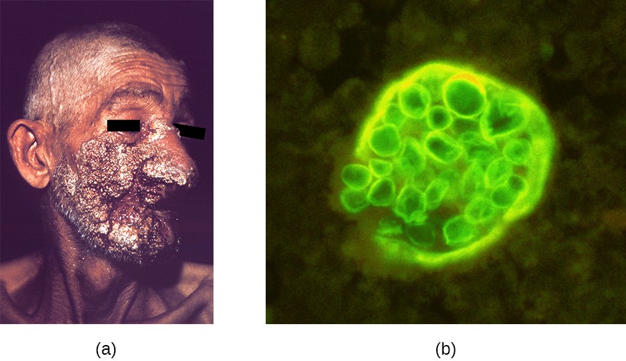 a) Large, dark lesions on a face. B) A microrgraph of spheres in a larger sphere.