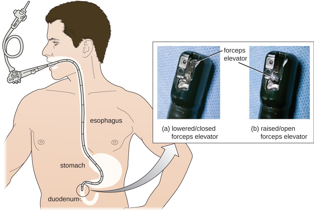 Diagram of a person with a duodenoscope inserted into their mouth – it travels through the esophagus and stomach to the duodenum. A photograph of the end of the scope shows a foreceps elevator in the lowered/closed and raised/open position.