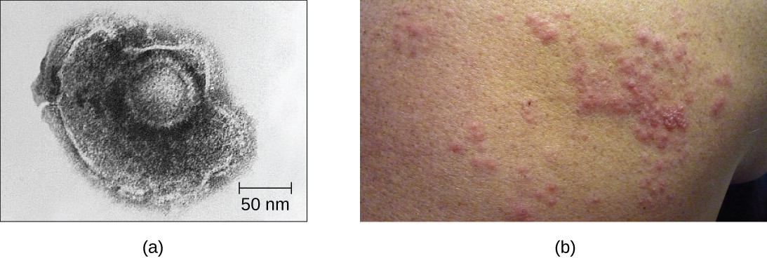 Figure a is an electron micrograph that shows a a shpere within a larger blob-shaped structure. Figure b shows raised red dots on a person’s back.