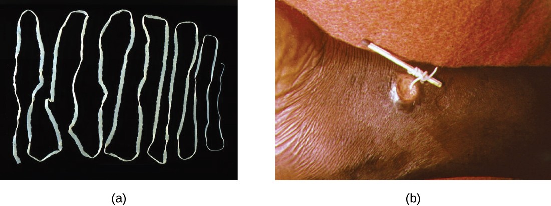 Figure a is a photograph of a long, flat, white worm folded back and forth on a black background. Figure b shows a lesion on a patient. A worm is being pulled out of the lesion and being wrapped around a matchstick
