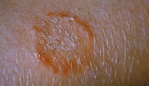 Close-up photo of a raised, red ring on skin.