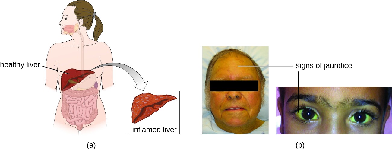 A) Shows an illustration comparing a healthy liver to an inflamed liver. B) A woman with yellowing eyes is shown and another with yellowing skin.
