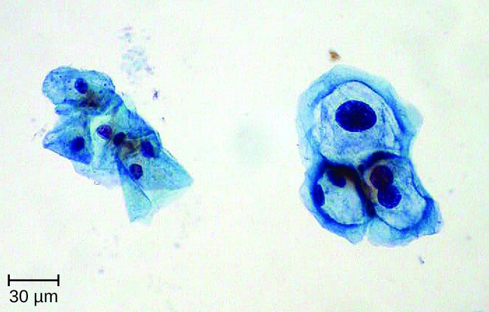 Micrograph of cells. On the left are thin flaky cells with nuclei. On the right are cells with much larger nuclei.