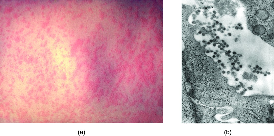 a) red bumps on a person's back. b) a micrograph of rubella.