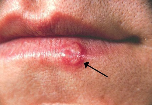 Photo of cold sore on a lip.