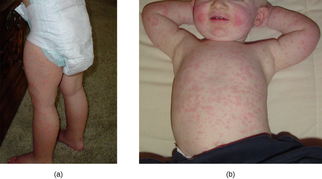 a) photo of red patches on an infant’s legs. B) photo of red spots on a child’s trunk.