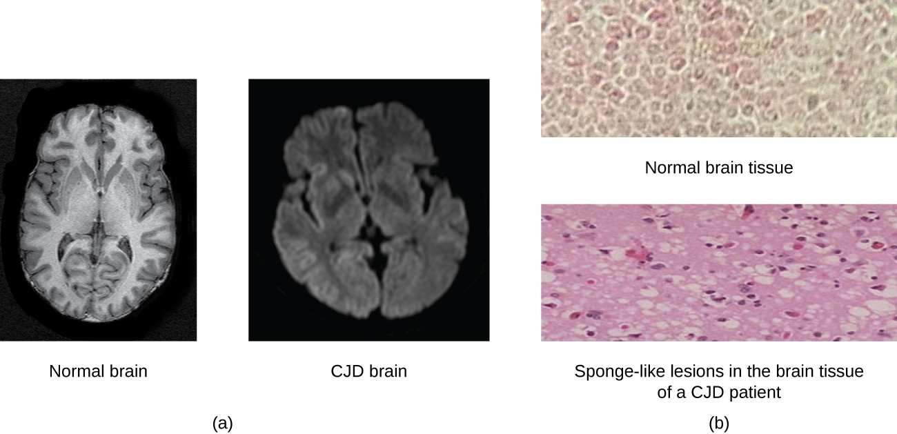The CJD brain has larger spaces as seen by more black regions in the image of the whole brain. The micrograph shows holes in the brain tissue.