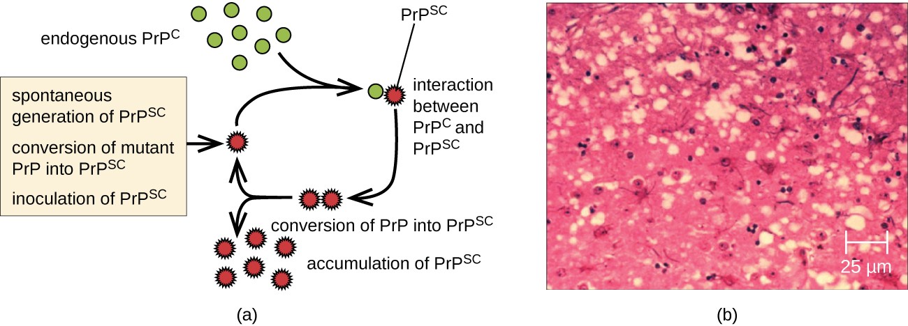 Figure A shows the process of how normal prion protein is converted to disease causing forms. Endogenous PrPc interact with PrpSC. This converts PRPC into PRPSC. The PRPSC accumulate. Figure B is a micrograph that shows holes in brain tissue.